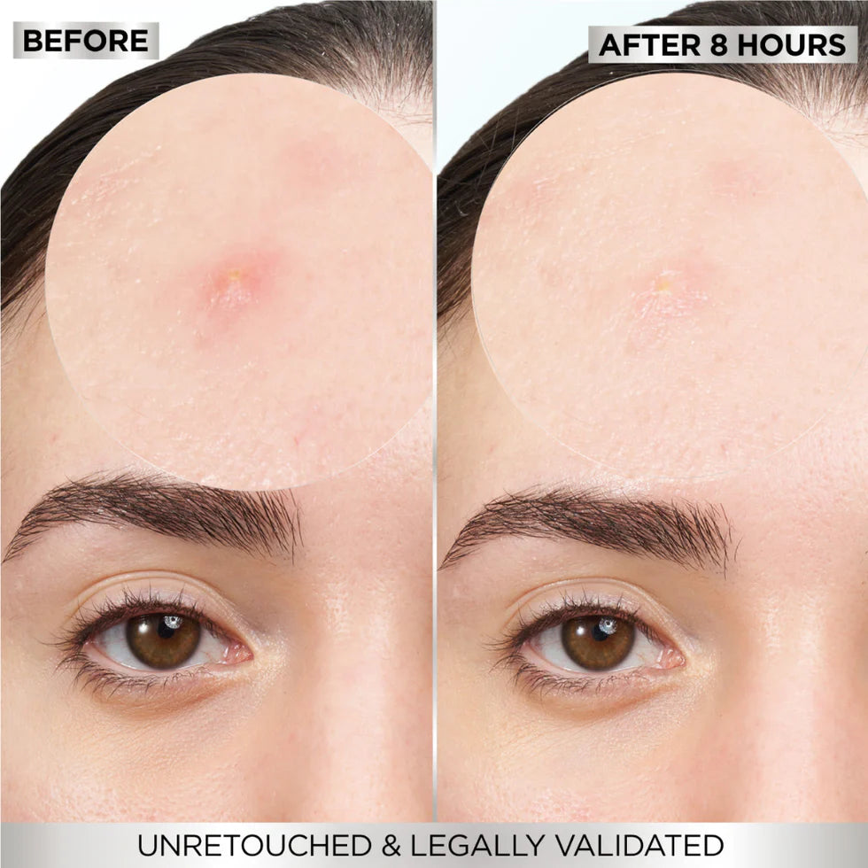 Fast Clear Invisible Pimple Patch 8 Hours Hydrocolloid